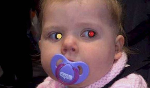 Tumore all’occhio di una neonata scoperto con una foto: ecco l’incredibile novità