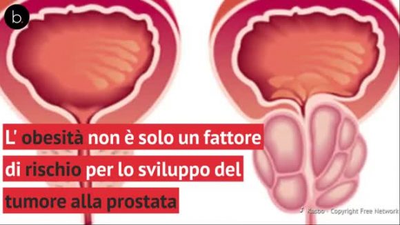 Tumore della prostata: un test delle urine da casa rileva sei hai il cancro