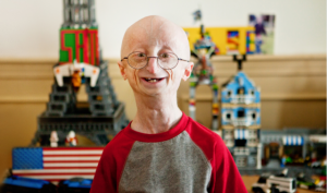 progeria-640&#215;377