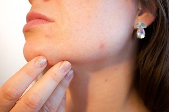 Vaccino contro l’acne, ecco le ultime novità