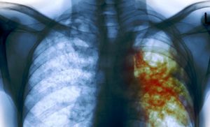 Tubercolosi: muore una 60 enne