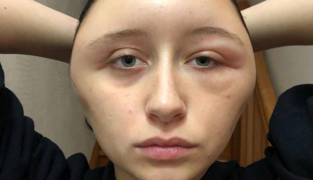 Dopo Aver Fatto La Tinta Per Capelli Si Ritrova Con Una Forte Reazione Allergica Dopo Aver Fatto La Tinta Per Capelli Si Ritrova Con Una Forte Reazione Allergica