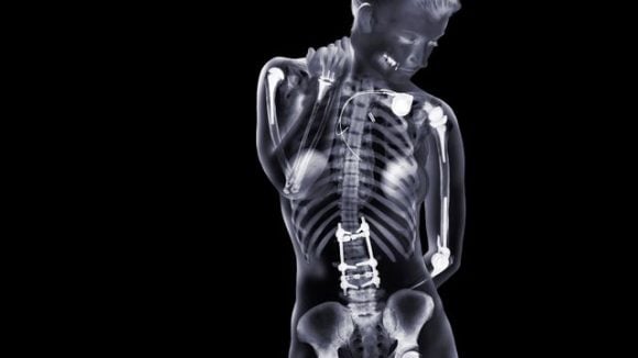 Allarme ‘’Implant Files’’, decessi e feriti a causa di protesi e impianti
