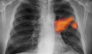 tumore polmonare