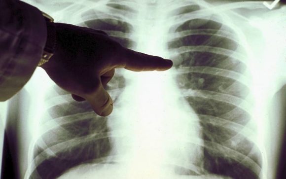 Tumore al polmone: saranno reclutati 10mila soggetti per uno studio che lo combatterà