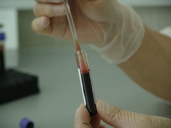 PanSeer, l’esame del sangue che individua precocemente 5 diversi tumori